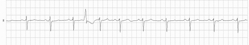 Interpolated VEBS Rhythm Strip